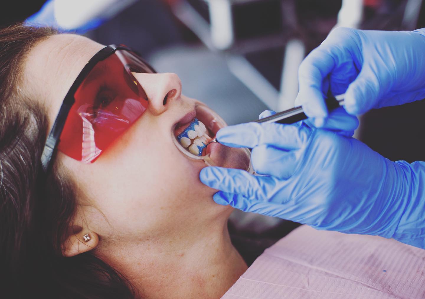 glo-whitening-at-first-street-dental